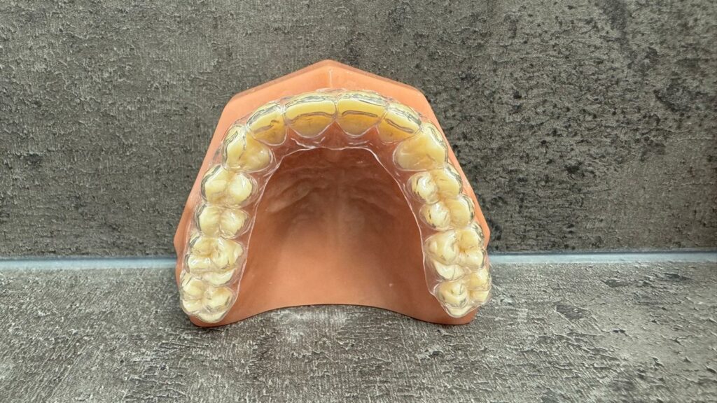 Lingual Braces