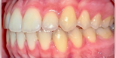 Case 1 - before and after treatment - after