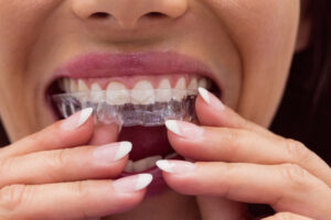 Clear aligner fitting